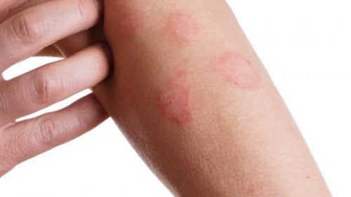 مرض بهجت: أسبابه، أعراضه وأكثر الأسئلة الشائعة حوله