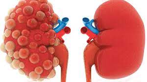 الفشل الكلوي اعراض